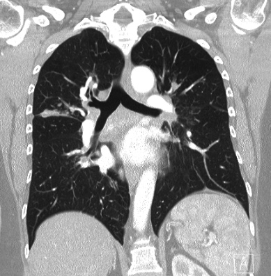 Cardiac sarcoidosis (Radiopaedia 74548-85534 Coronal lung window 40).jpg
