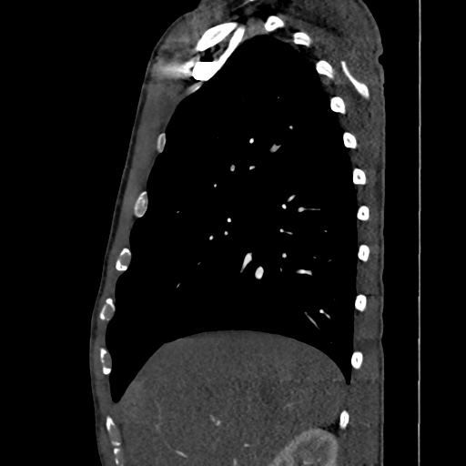 Cardiac tumor - undifferentiated pleomorphic sarcoma (Radiopaedia 45844-50134 B 62).png