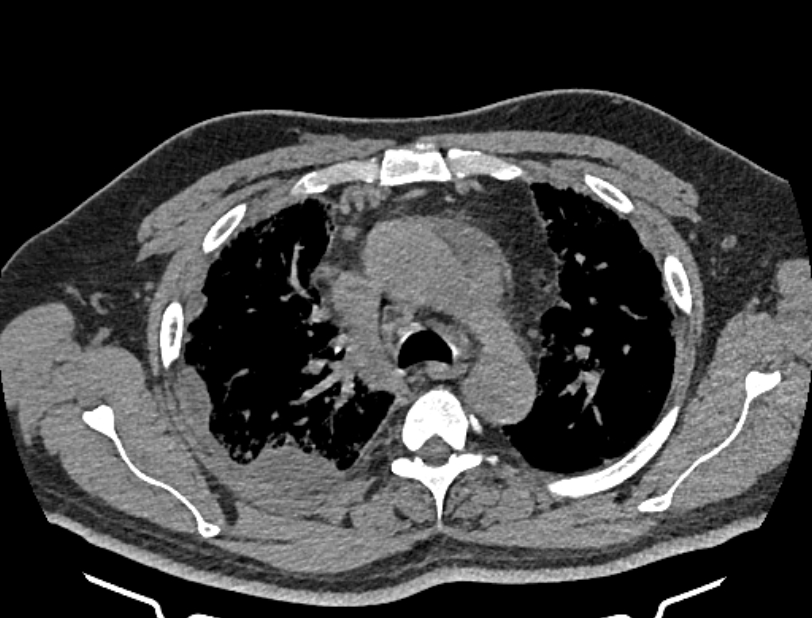 Cardiogenic pulmonary edema (Radiopaedia 68180-77678 Axial non-contrast 14).jpg