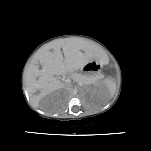 Caroli disease with autosomal recessive polycystic kidney disease (ARPKD) (Radiopaedia 89651-106703 B 72).jpg