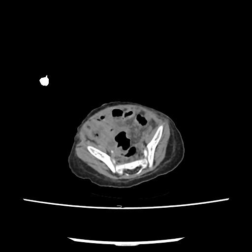 Caroli disease with autosomal recessive polycystic kidney disease (ARPKD) (Radiopaedia 89651-106703 E 196).jpg