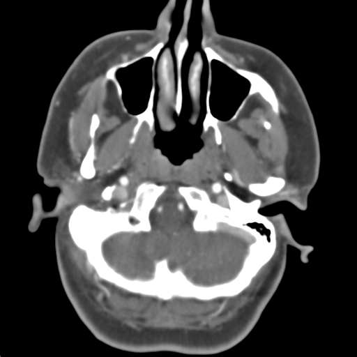 Carotico ophthalmic aneurysm (Radiopaedia 42916-46148 A 47).png