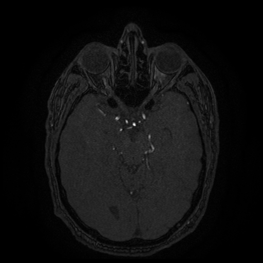 Carotid arterial dissection with acute cerebral infarction (Radiopaedia 26636-26784 MRA 100).jpg