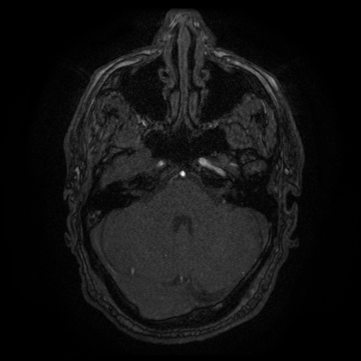 Carotid arterial dissection with acute cerebral infarction (Radiopaedia 26636-26784 MRA 131).jpg