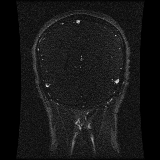 File:Carotid arterial dissection with acute cerebral infarction (Radiopaedia 26636-26784 MRV 65).jpg