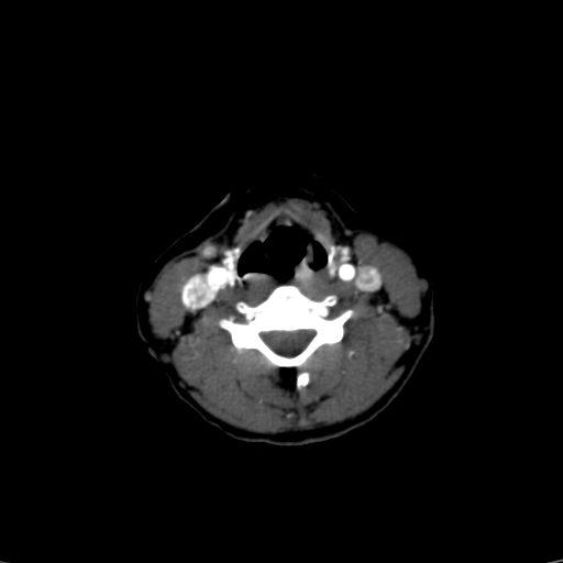 Carotid body tumor (Radiopaedia 39845-42300 B 20).jpg