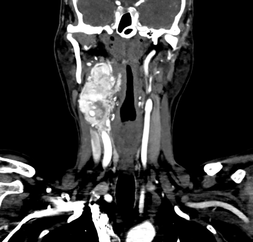 File:Carotid body tumor (Radiopaedia 83615-98727 B 65).jpg
