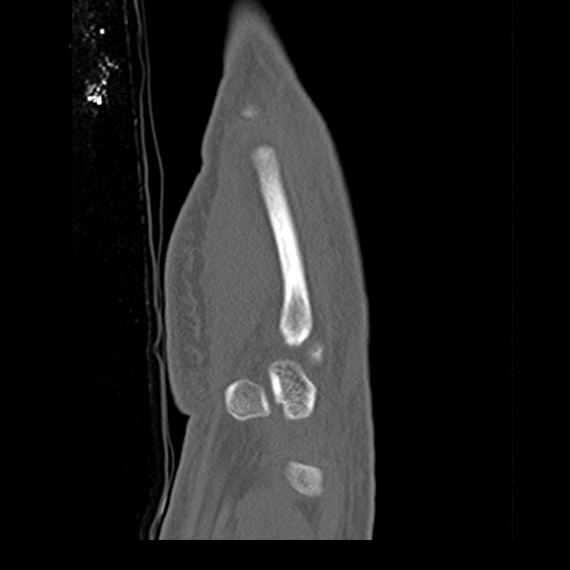 File:Carpo-metacarpal fracture-dislocations with hamatum split fracture (Radiopaedia 18482-18343 Sagittal bone window 5).jpg