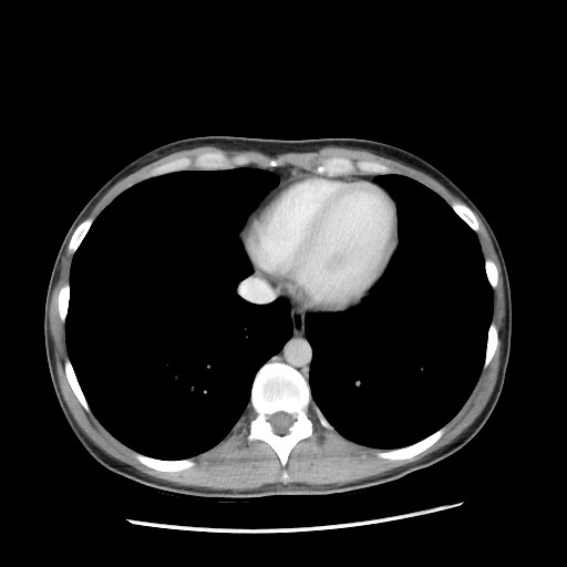 Castleman disease with fibrous pseudotumor in the abdomen (Radiopaedia 77296-89373 A 7).jpg
