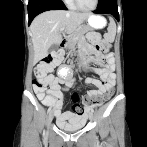 File:Castleman disease with fibrous pseudotumor in the abdomen (Radiopaedia 77296-89373 B 35).jpg