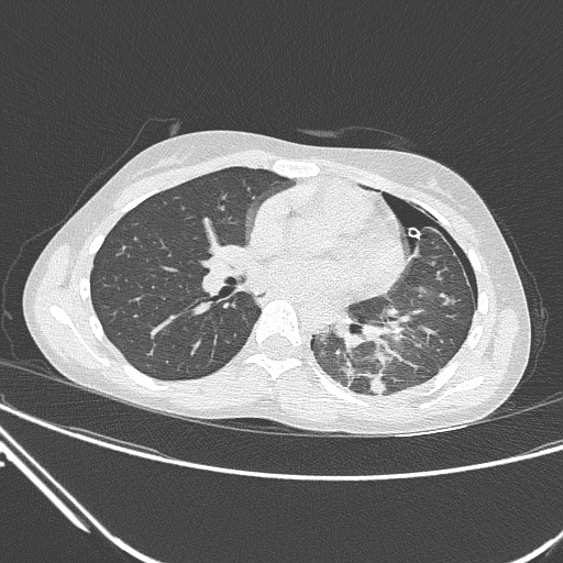 Catamenial pneumothorax (Radiopaedia 27946-28197 lung window 86).jpg