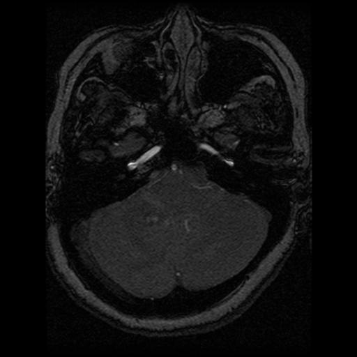 Cavernoma, DVA and right ICA aneurysm (Radiopaedia 33890-35072 E 85).png