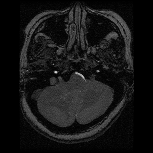Cavernoma, DVA and right ICA aneurysm (Radiopaedia 33890-35072 E 92).png