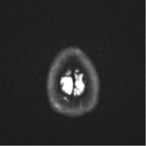 Cavernoma with bleed - midbrain (Radiopaedia 54546-60774 Axial DWI 27).png