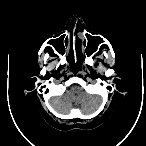 Cavernous hemangioma of the cerebellar falx (Radiopaedia 73025-83723 Axial non-contrast 15).jpg
