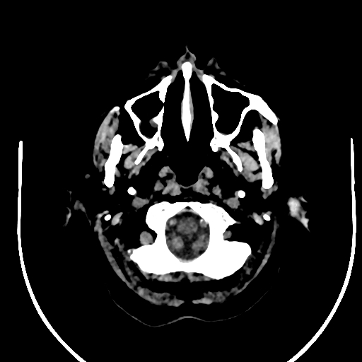 Cavernous hemangioma of the cerebellar falx (Radiopaedia 73025-83723 Axial non-contrast 7).jpg