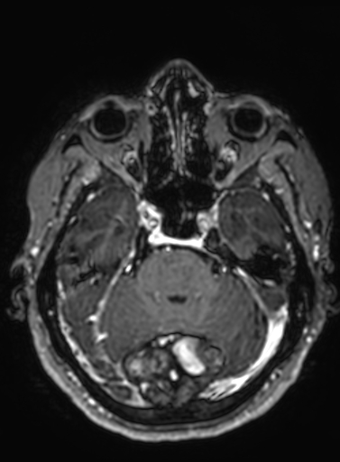 Cavernous hemangioma of the cerebellar falx (Radiopaedia 73025-83724 Axial T1 C+ 237).jpg