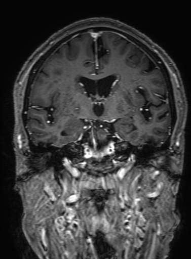 Cavernous hemangioma of the cerebellar falx (Radiopaedia 73025-83724 Coronal T1 C+ 181).jpg
