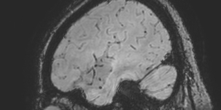 File:Cavernous hemangioma of the cerebellar falx (Radiopaedia 73025-83724 Sagittal BOLD 169).jpg