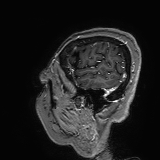 File:Cavernous hemangioma of the cerebellar falx (Radiopaedia 73025-83724 Sagittal T1 C+ 187).jpg