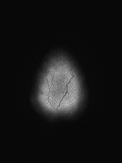 File:Cavernous malformation (cavernous angioma or cavernoma) (Radiopaedia 36675-38237 Axial T2 FLAIR 23).png