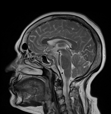 File:Cavernous sinus meningioma (Radiopaedia 63682-72367 Sagittal T2 11).jpg