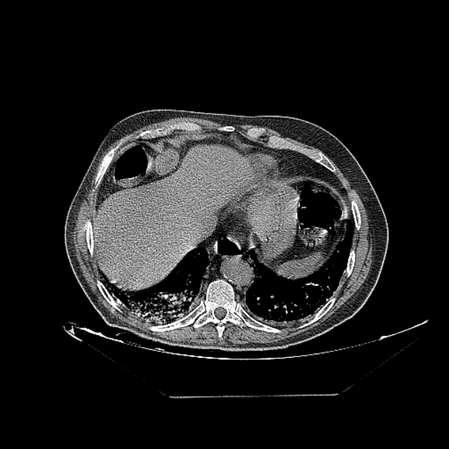 Cavitating bronchogenic carcinoma (Radiopaedia 44489-48162 Axial non-contrast 70).jpg