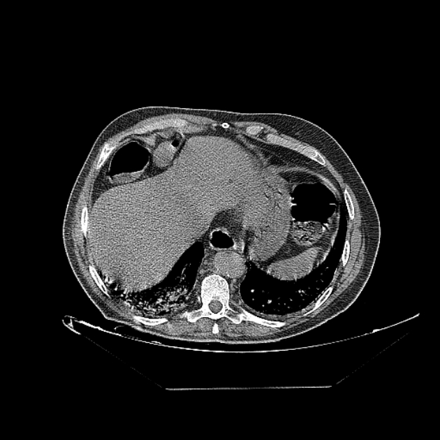 Cavitating bronchogenic carcinoma (Radiopaedia 44489-48162 Axial non-contrast 72).jpg