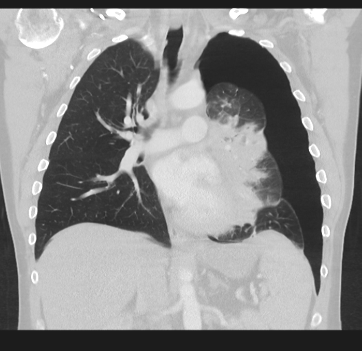 Cavitating pneumonia complicated by pneumothorax (Radiopaedia 48149-52994 Coronal lung window 31).png
