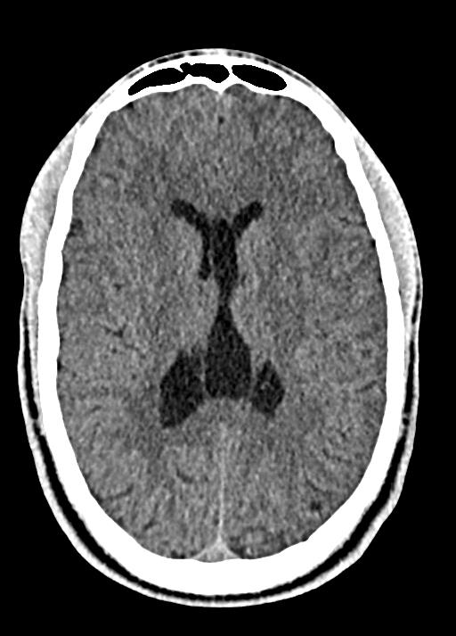 Cavum septum pellucidum and cavum vergae (Radiopaedia 77797-90060 Axial Brain Window 60).jpg