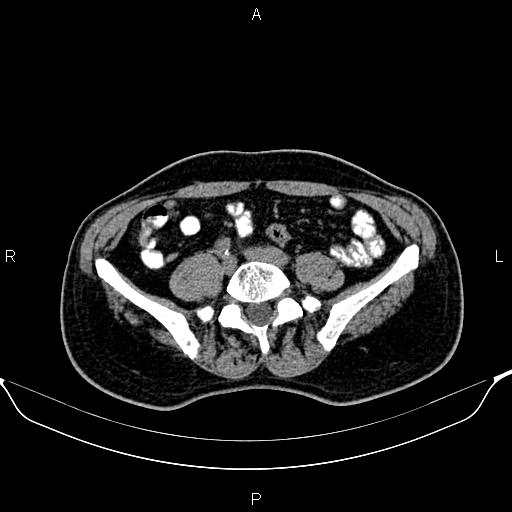 Cecal adenocarcinoma (Radiopaedia 85324-100916 Axial non-contrast 65).jpg