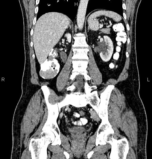 Cecal adenocarcinoma (Radiopaedia 85324-100916 D 43).jpg