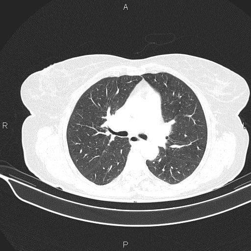 Cecal cancer (Radiopaedia 85610-101358 Axial lung window 28).jpg