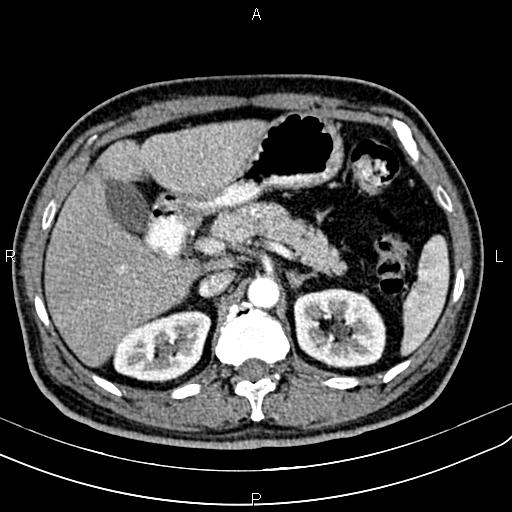 File:Cecal cancer with appendiceal mucocele (Radiopaedia 91080-108651 A 71).jpg