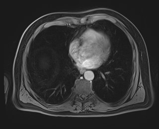 Cecal mass causing appendicitis (Radiopaedia 59207-66532 J 11).jpg