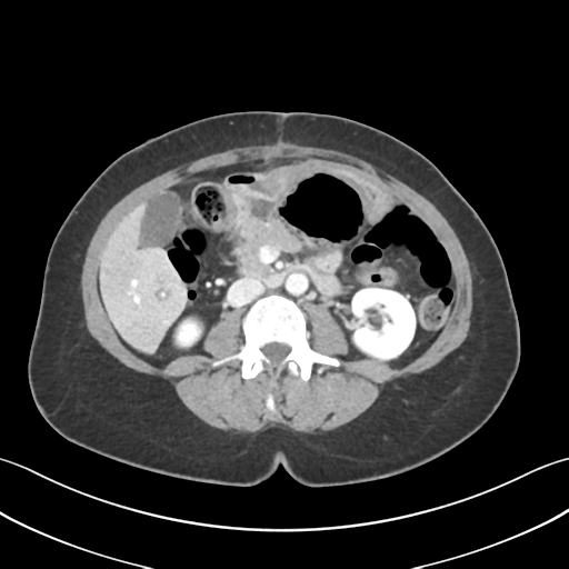Cecum hernia through the foramen of Winslow (Radiopaedia 46634-51112 A 34).png