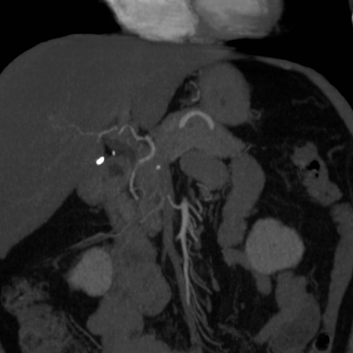 File:Celiac artery compression by the diaphragmatic crurae (Radiopaedia 31739-32666 B 1).jpg