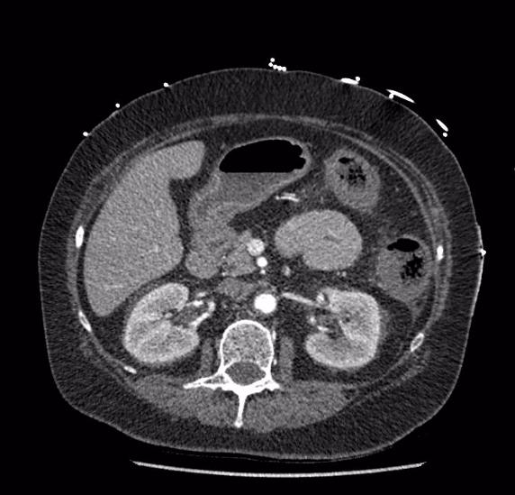 File:Celiac artery severe stenosis and dissection (Radiopaedia 44128-47842 B 35).jpg