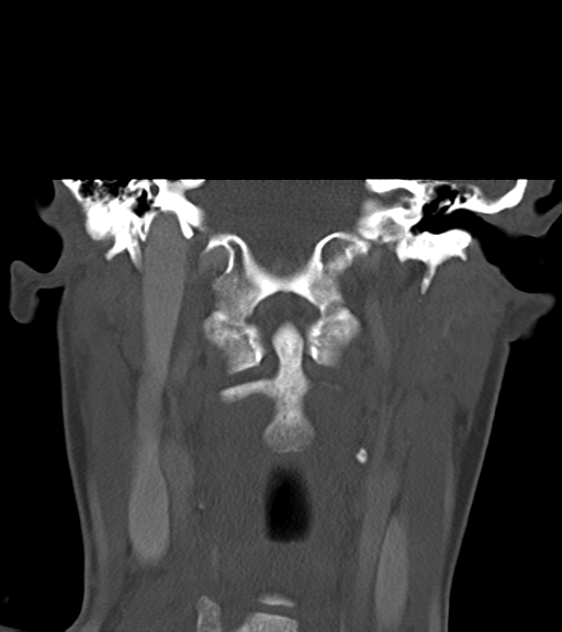 File:Cemento-ossifying fibroma (Radiopaedia 46243-50643 Coronal bone window 41).png
