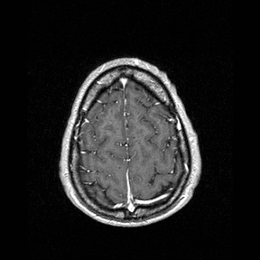 Central-variant posterior reversible encephalopathy syndrome (PRES) (Radiopaedia 43880-47358 Axial T1 C+ 147).jpg