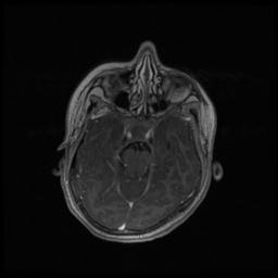 Central neurocytoma (Radiopaedia 30220-30842 Axial T1 C+ 49).jpg