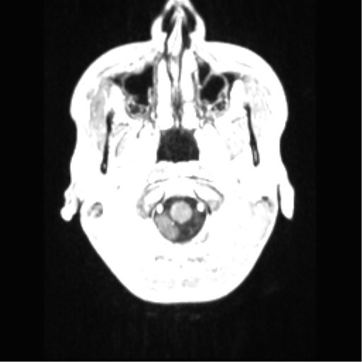 File:Central neurocytoma (Radiopaedia 37664-39557 Axial T1 C+ 8).png