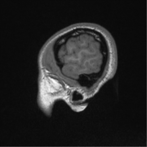 Central neurocytoma (Radiopaedia 37664-39557 Sagittal T1 12).png