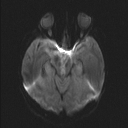 Central neurocytoma (Radiopaedia 56690-63469 Axial DWI 25).jpg