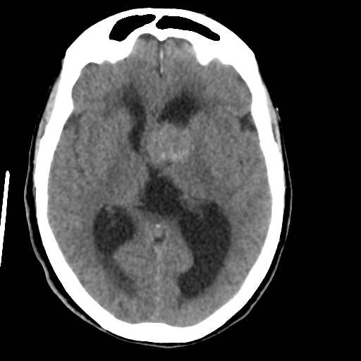 Central neurocytoma (Radiopaedia 65317-74346 Axial non-contrast 25).png