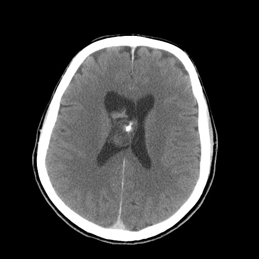 File:Central neurocytoma (Radiopaedia 68725-78432 Axial C+ 53).jpg