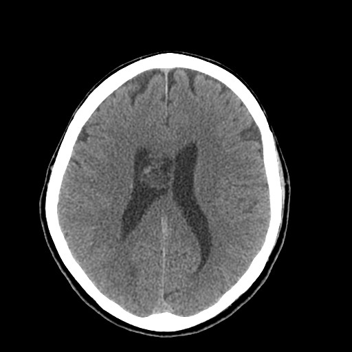 Central neurocytoma (Radiopaedia 68725-78432 Axial non-contrast 32).jpg