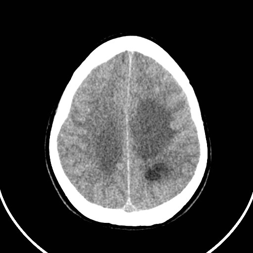 Central neurocytoma (Radiopaedia 84497-99871 Axial non-contrast 39).jpg