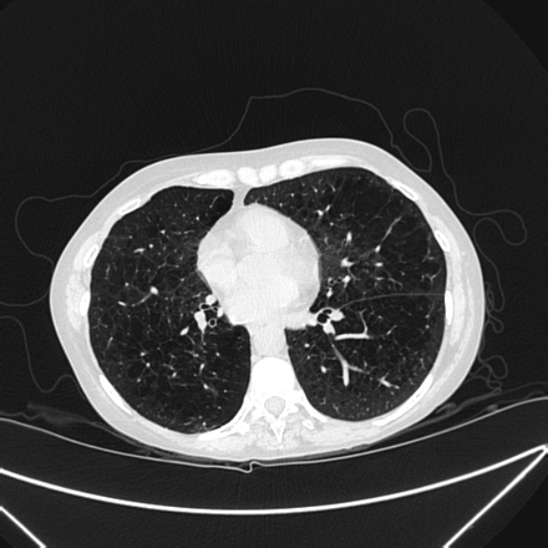 Centrilobular pulmonary emphysema (Radiopaedia 24495-24789 Axial lung window 57).jpg