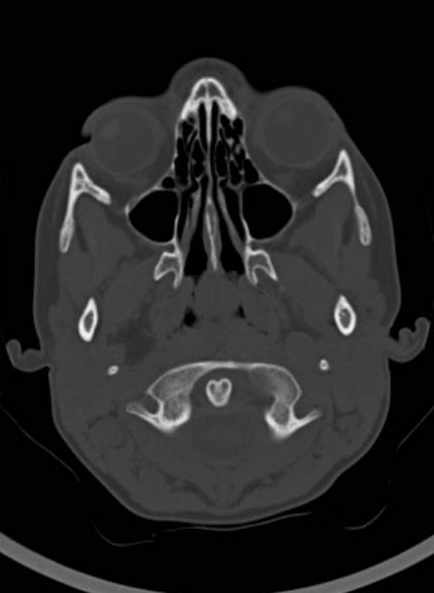 Cerebellar abscess (Radiopaedia 73727-84527 Axial bone window 17).jpg
